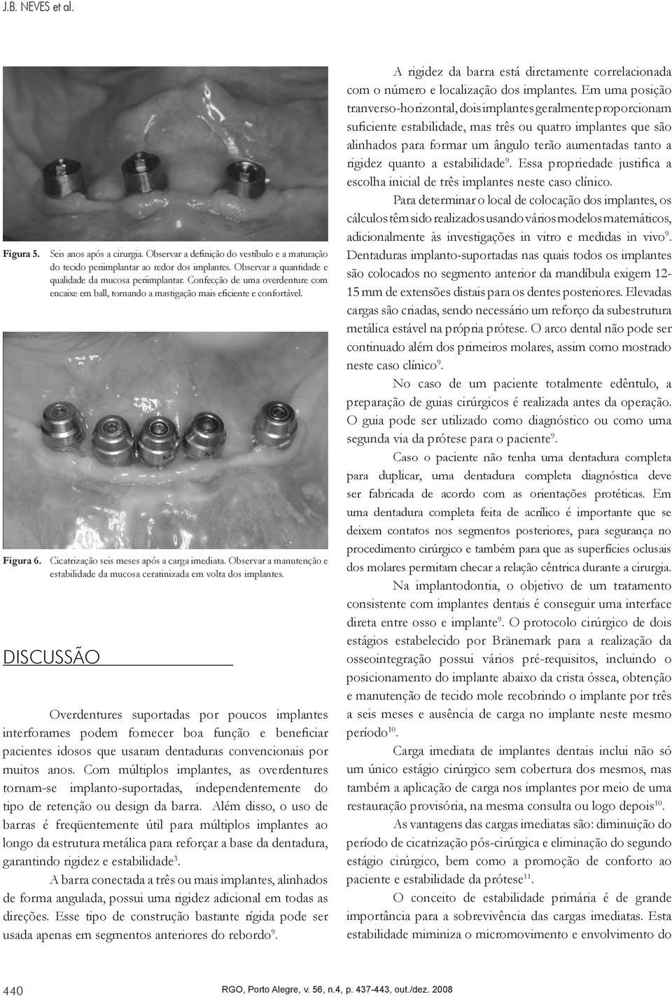 Cicatrização seis meses após a carga imediata. Observar a manutenção e estabilidade da mucosa ceratinizada em volta dos implantes.