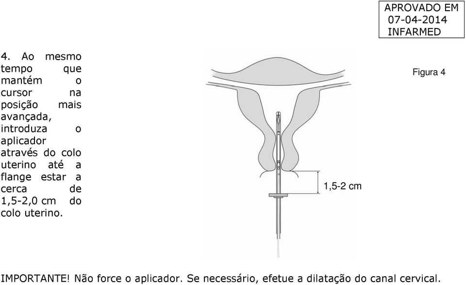 cerca de 1,5-2,0 cm do colo uterino.