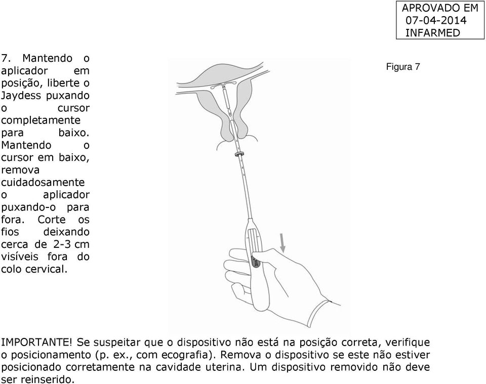 Corte os fios deixando cerca de 2-3 cm visíveis fora do colo cervical. Figura 7 IMPORTANTE!