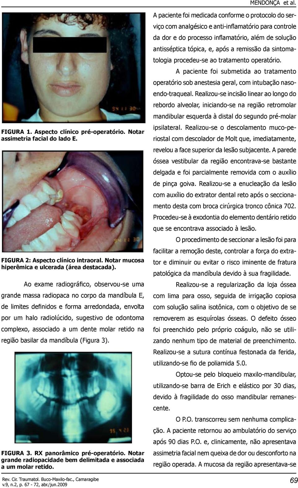 associado a um dente molar retido na região basilar da mandíbula (Figura 3). FIGURA 3. RX panorâmico pré-operatório. Notar grande radiopacidade bem delimitada e associada a um molar retido.