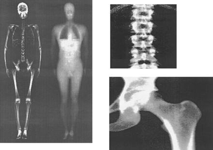 Métodos imagiológicos Foram desenvolvidos DXA com software que