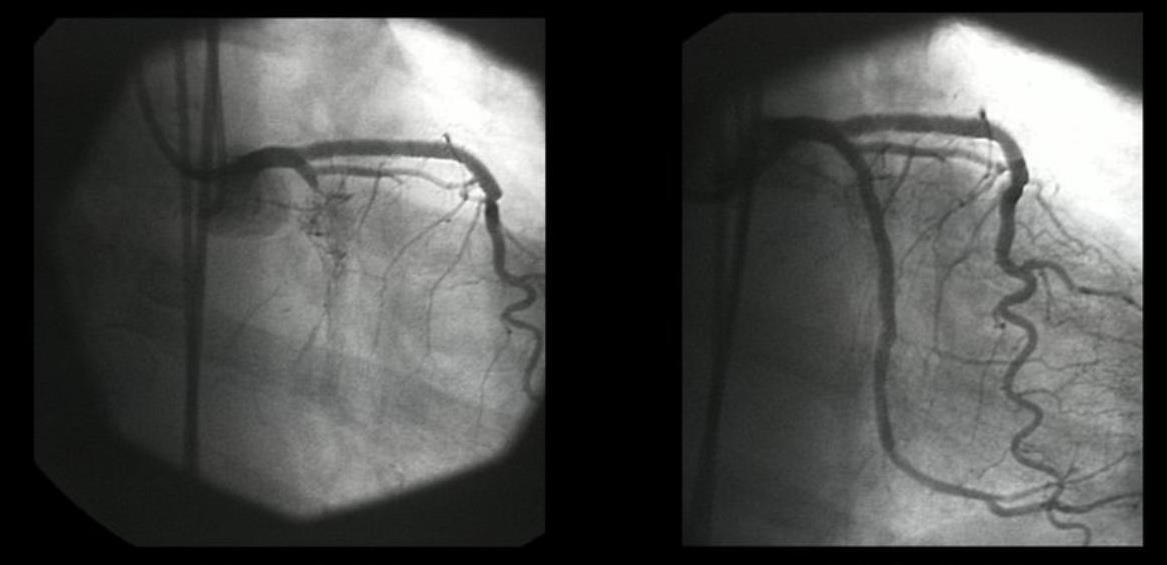 Antes Oclusão Cx proximal Depois angioplastia + colocação de