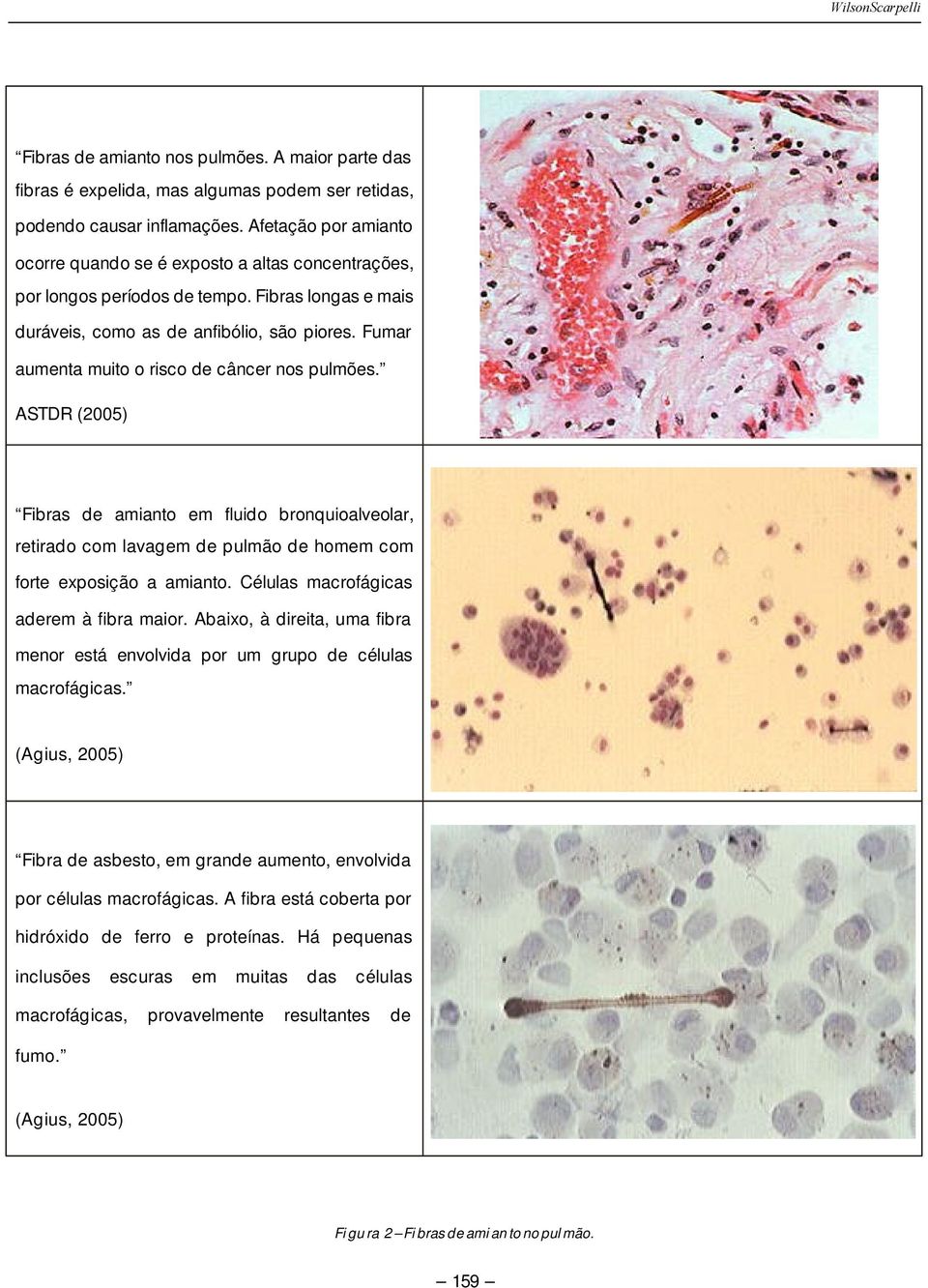 Fumar aumenta muito o risco de câncer nos pulmões. ASTDR (2005) Fibras de amianto em fluido bronquioalveolar, retirado com lavagem de pulmão de homem com forte exposição a amianto.