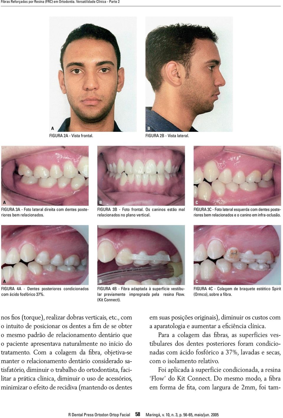 FIGUR 3C - Foto lateral esquerda com dentes posteriores bem relacionados e o canino em infra-oclusão. C FIGUR 4 - Dentes posteriores condicionados com ácido fosfórico 37%.