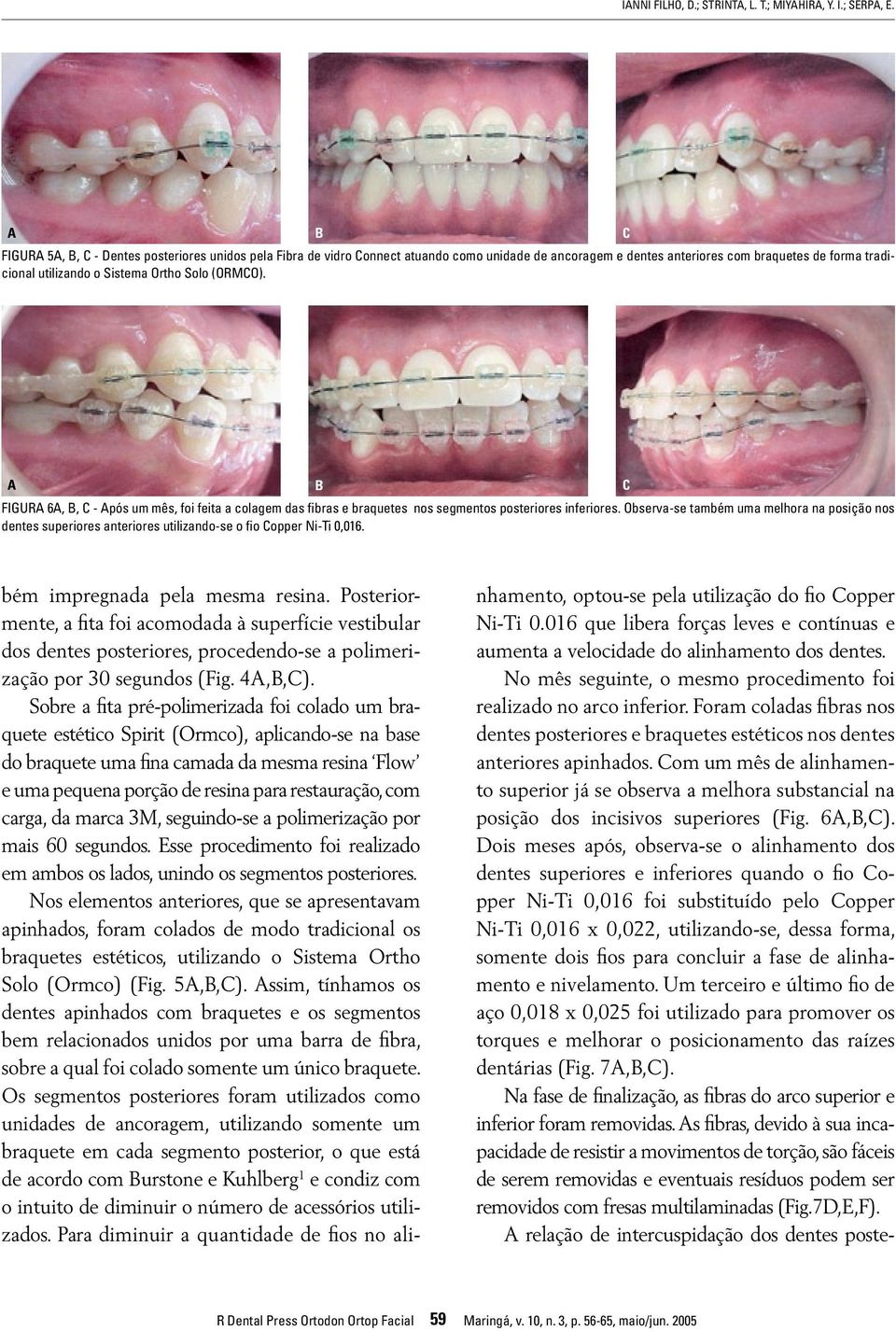 FIGUR 6,, C - pós um mês, foi feita a colagem das fibras e braquetes nos segmentos posteriores inferiores.