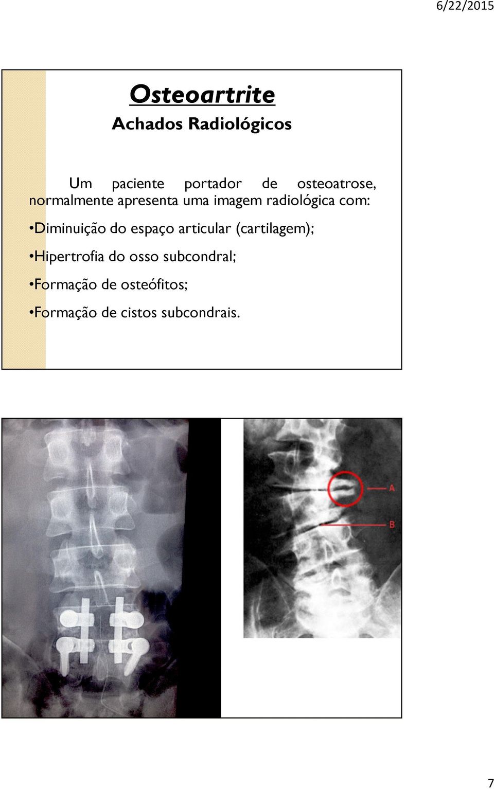 do espaço articular (cartilagem); Hipertrofia do osso
