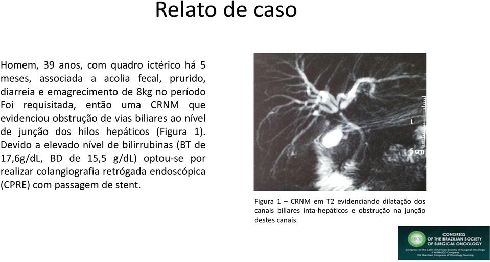 Devido a elevado nível de bilirrubinas (BT de 17,6g/dL, BD de 15,5 g/dl) optou-se por realizar colangiografia retrógada endoscópica