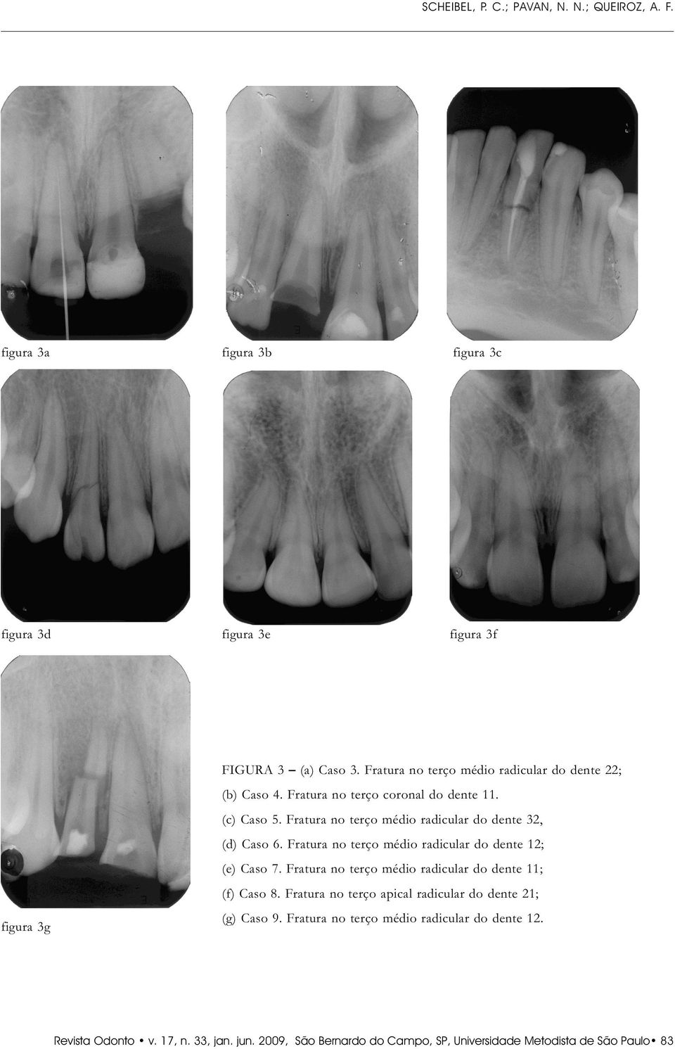 Fratura no terço médio radicular do dente 32, (d) Caso 6. Fratura no terço médio radicular do dente 12; (e) Caso 7.