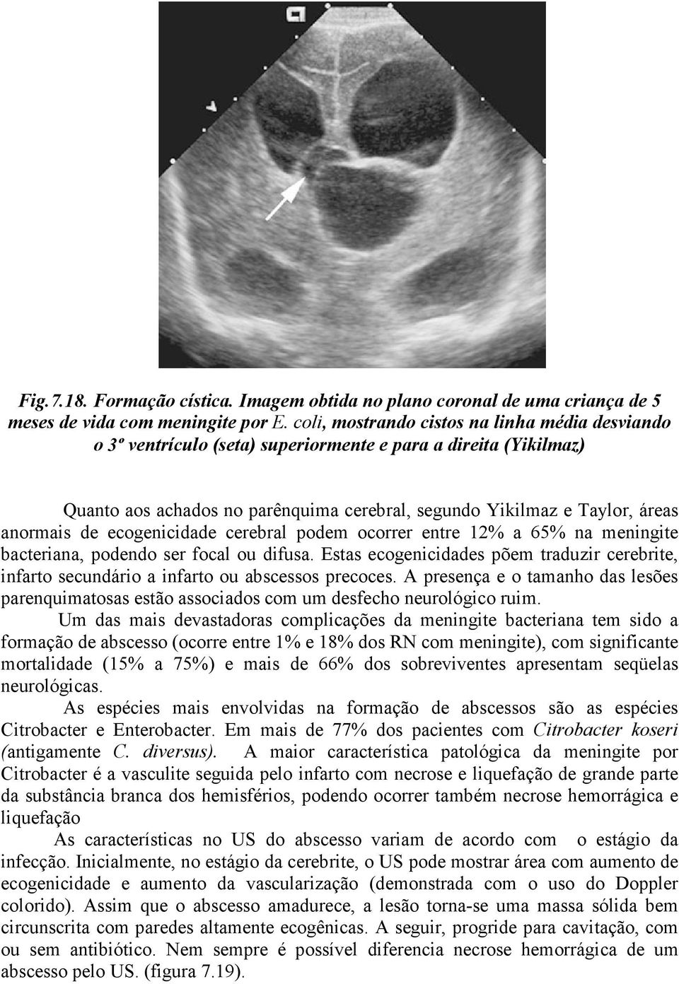 de ecogenicidade cerebral podem ocorrer entre 12% a 65% na meningite bacteriana, podendo ser focal ou difusa.