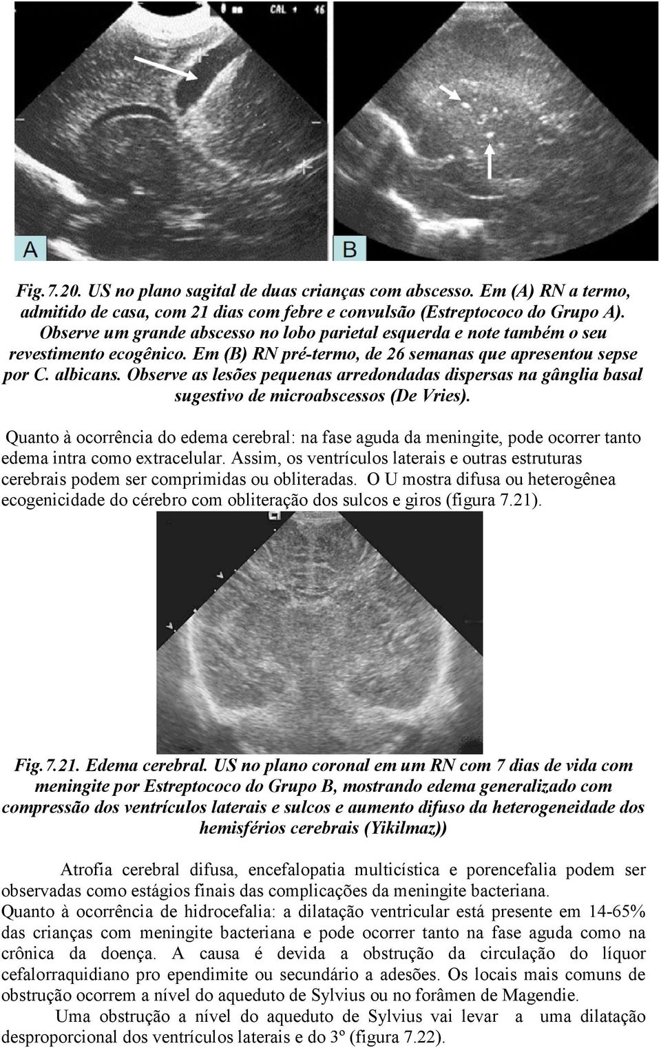 Observe as lesões pequenas arredondadas dispersas na gânglia basal sugestivo de microabscessos (De Vries).