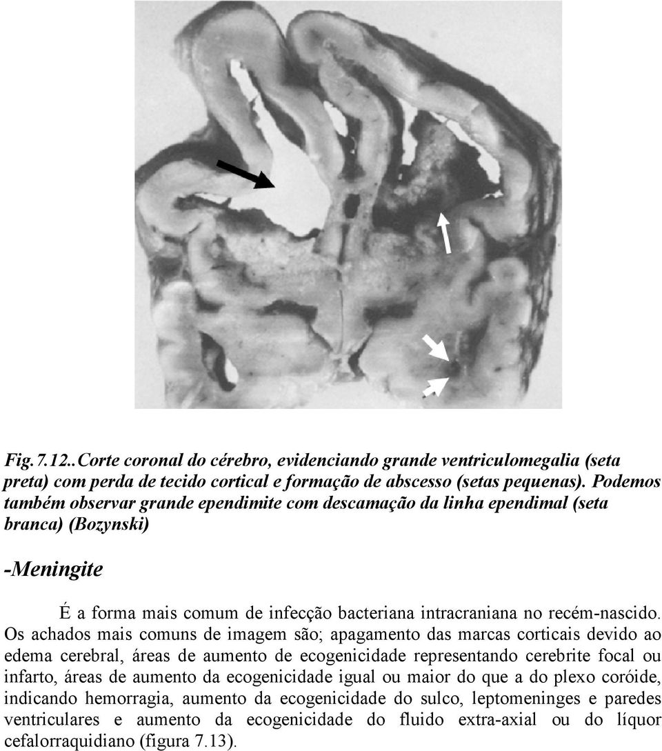 Os achados mais comuns de imagem são; apagamento das marcas corticais devido ao edema cerebral, áreas de aumento de ecogenicidade representando cerebrite focal ou infarto, áreas de aumento da