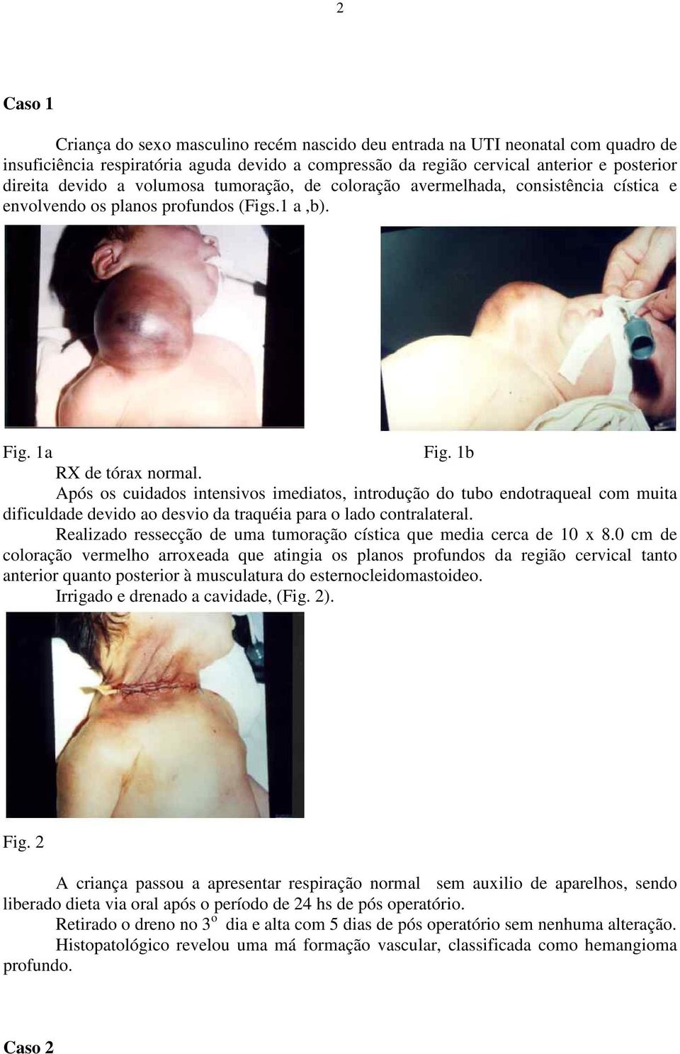 Após os cuidados intensivos imediatos, introdução do tubo endotraqueal com muita dificuldade devido ao desvio da traquéia para o lado contralateral.