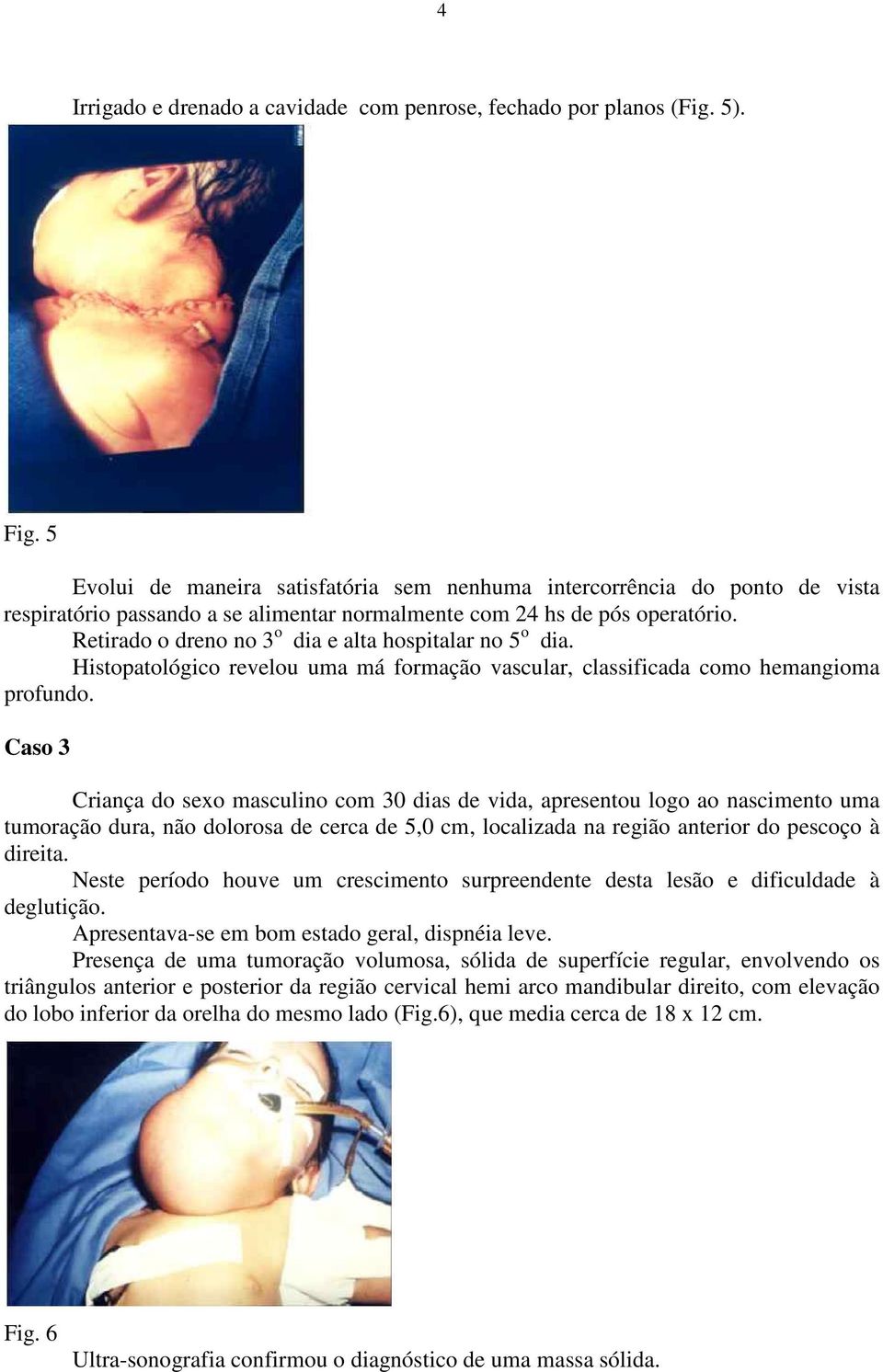 Retirado o dreno no 3 o dia e alta hospitalar no 5 o dia. Histopatológico revelou uma má formação vascular, classificada como hemangioma profundo.