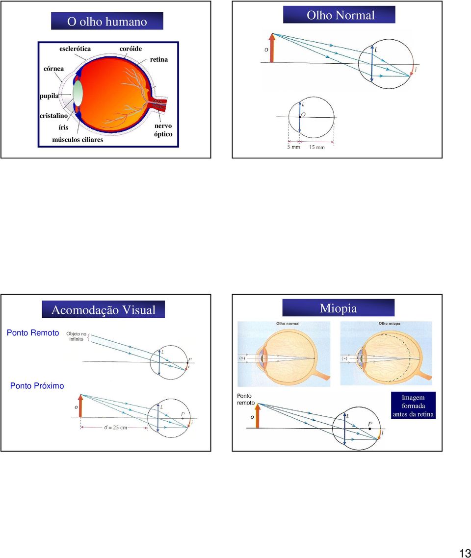 ciliares nervo óptico Acomodação Visual Miopia