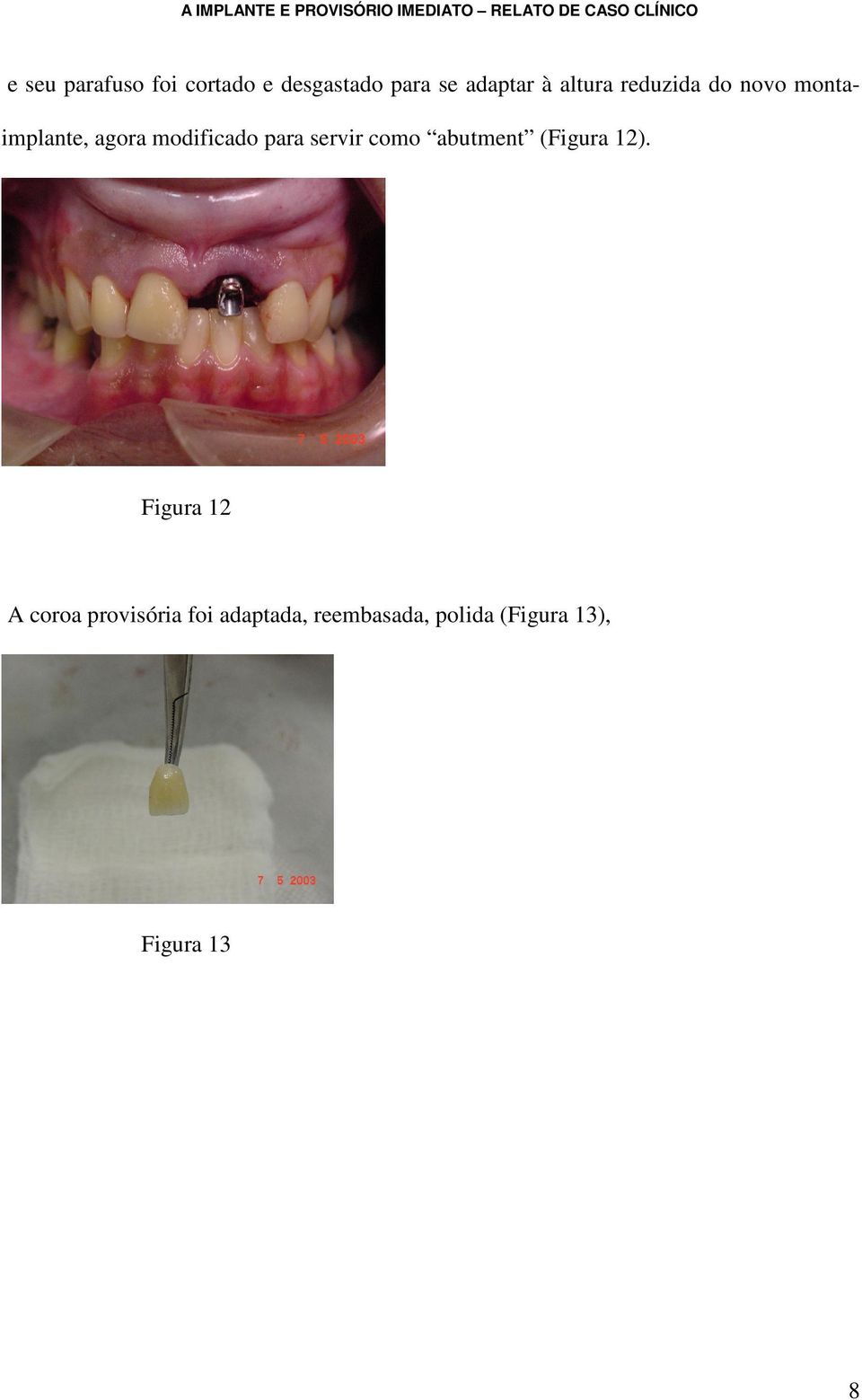 para servir como abutment (Figura 12).