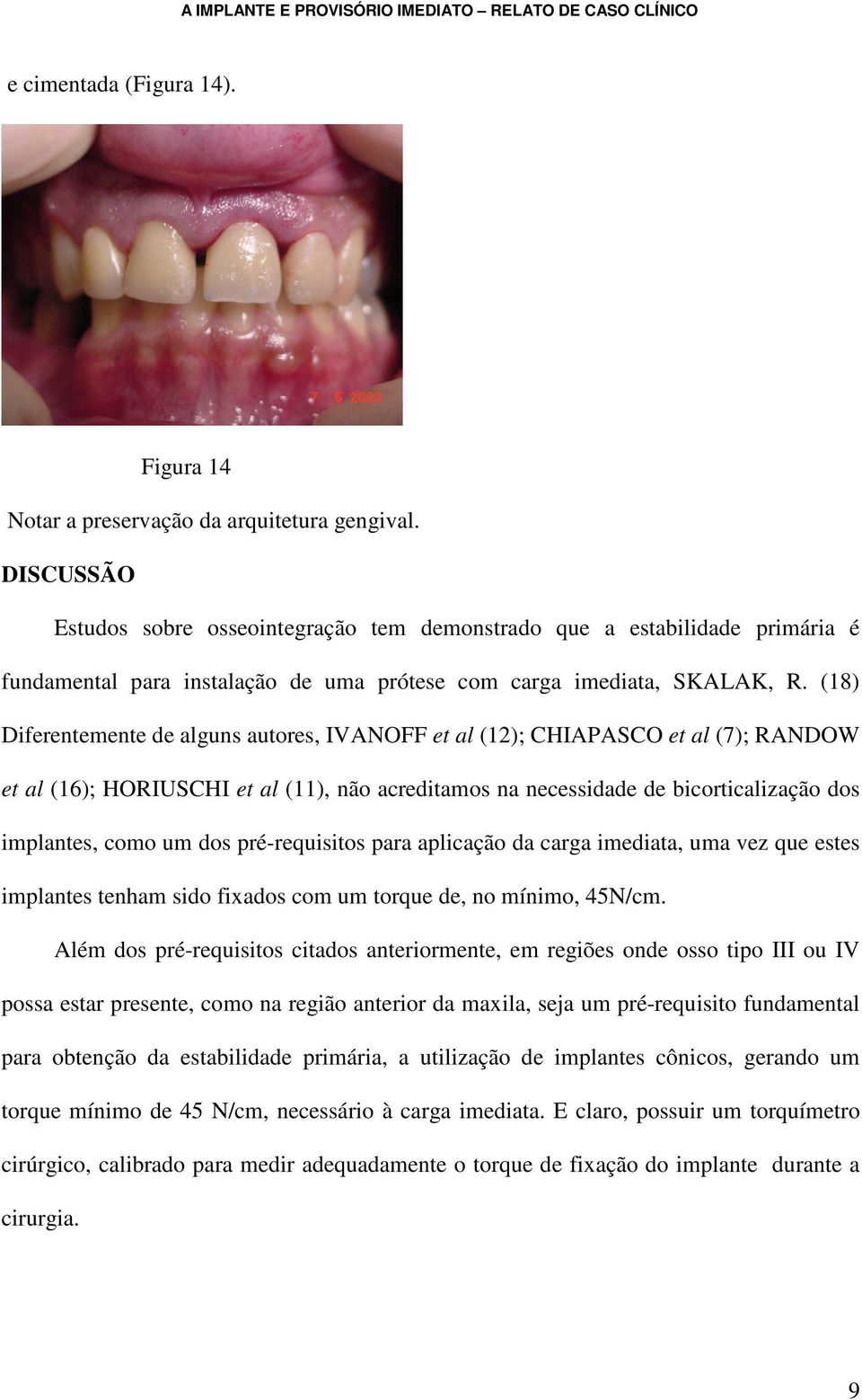 (18) Diferentemente de alguns autores, IVANOFF et al (12); CHIAPASCO et al (7); RANDOW et al (16); HORIUSCHI et al (11), não acreditamos na necessidade de bicorticalização dos implantes, como um dos