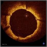 Análise de cobertura endotelial: TCO Lesions with at least 5% uncovered struts Lesions with at least 5% malapposed struts p = 0.005 10 x p = 0.04 20 x 10 60 39.4 % 40 % 5 20 3.