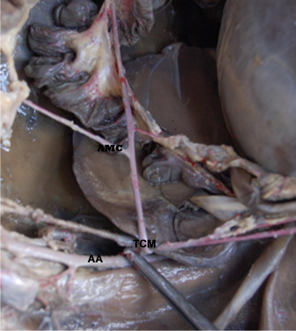 33 Figura 2. Fotomacrografia mostrando o tronco celíaco-mesentérico e sua origem a partir da artéria aorta. AA artéria aorta, TCM tronco celíaco-mesentérico. Figura 3.