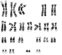 AULA PRÁTICA SOBRE CARIÓTIPO - Pg 3 cromossomo Y. Os pares 21, 22 e o Y são os menores acrocêntricos. Os pares 21 e 22 apresentam satélites nem sempre visíveis nos braços curtos.