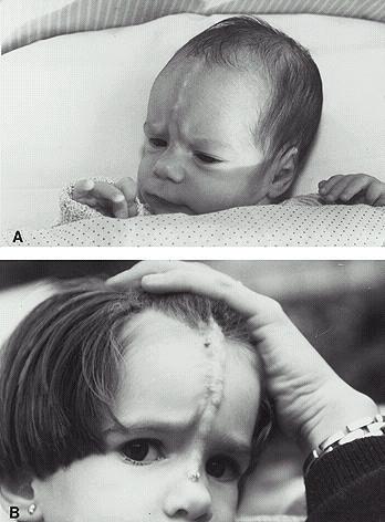 OSSOS HETEROTÓPICOS FIG. 1. Severe progressive POC in the forehead of a child.