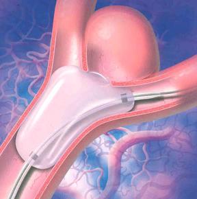 tratamento de aneurismas de