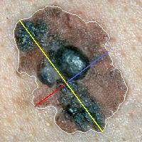 uma lesão do tipo melanoma, onde os ruídos (pêlos) foram amenizados seletivamente. (a) Figura 3. Resultado da suavização: (a) imagem original e (b) imagem suavizada. 4.2.