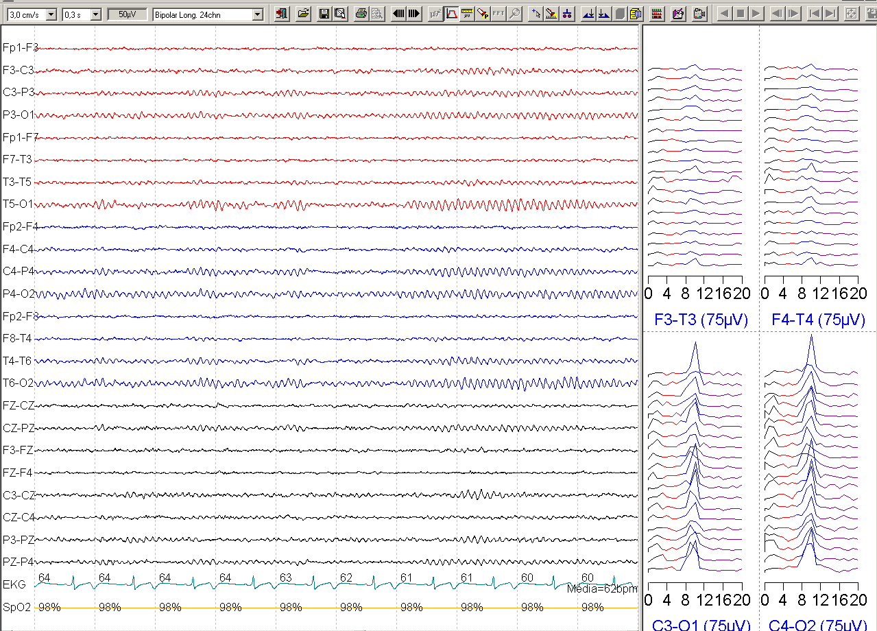 20 a, M: 10 s de EEG (tempo) e 4 s/linha de