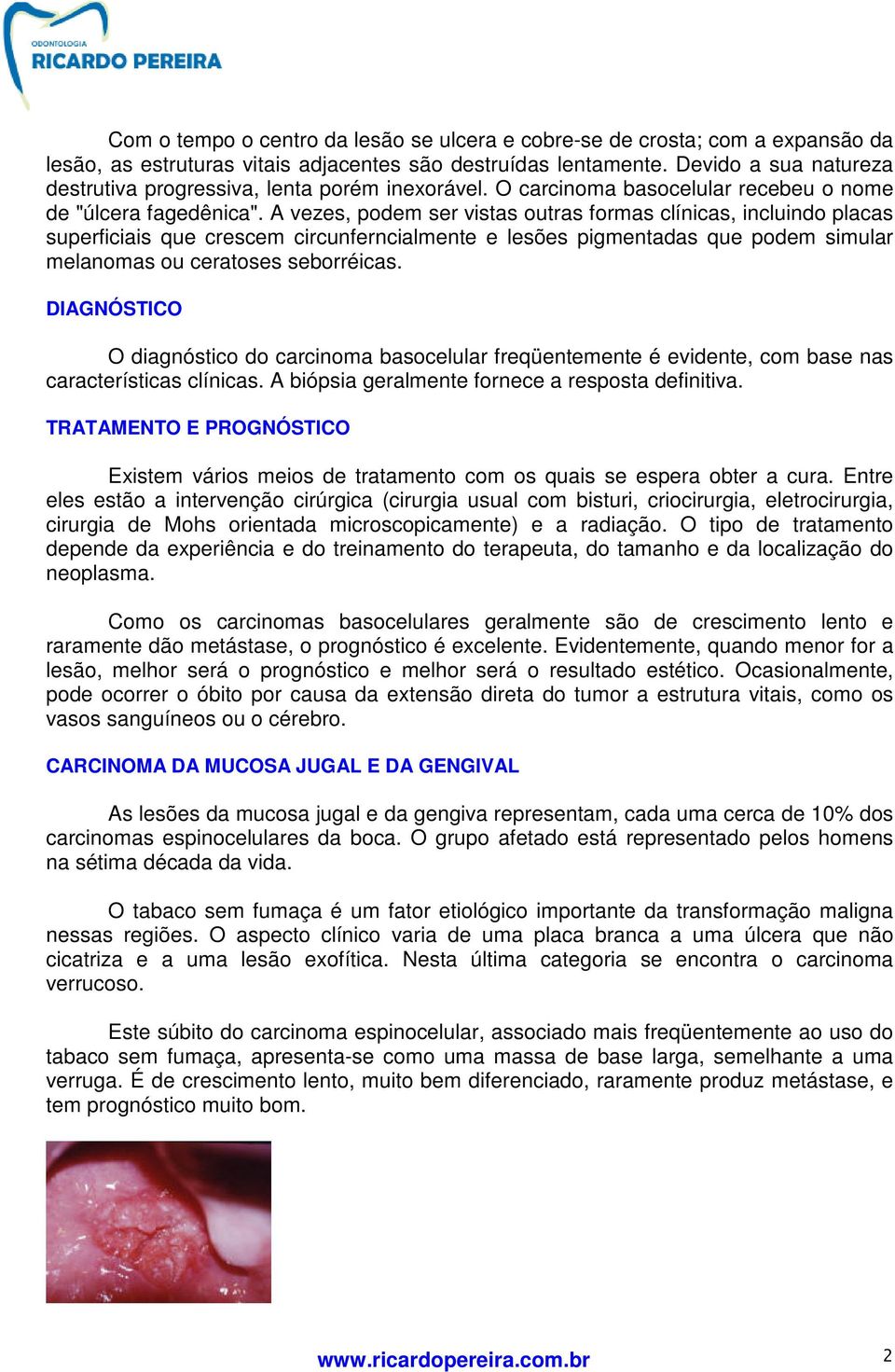 A vezes, podem ser vistas outras formas clínicas, incluindo placas superficiais que crescem circunferncialmente e lesões pigmentadas que podem simular melanomas ou ceratoses seborréicas.