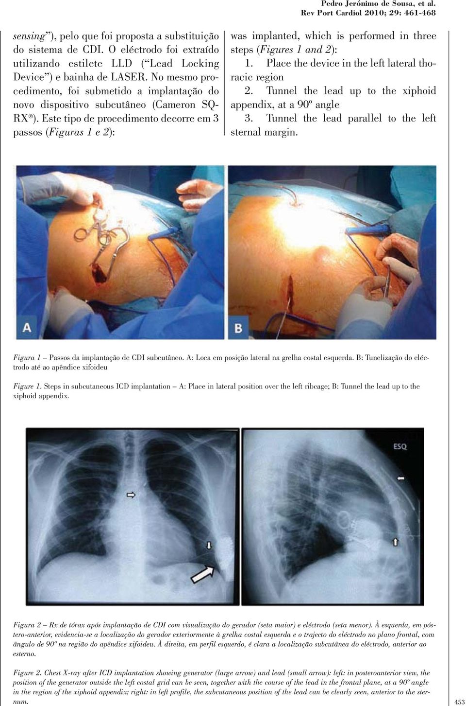 Este tipo de procedimento decorre em 3 passos (Figuras 1 e 2): was implanted, which is performed in three steps (Figures 1 and 2): 1. Place the device in the left lateral thoracic region 2.