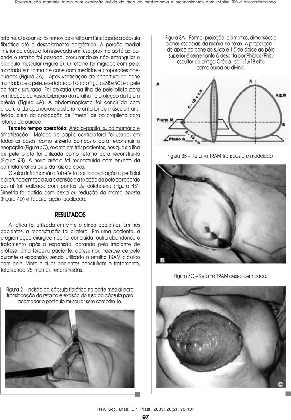 A porção medial inferior da cápsula foi ressecada em fuso, próximo ao tórax, por onde o retalho foi passado, procurando-se não estrangular o pedículo muscular (Figura 2).