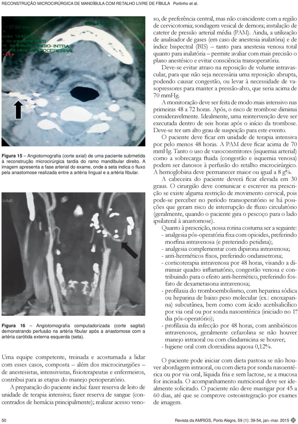 Figura 16 Angiotomografi a computadorizada (corte sagital) demonstrando perfusão na artéria fi bular após a anastomose com a artéria carótida externa esquerda (seta).