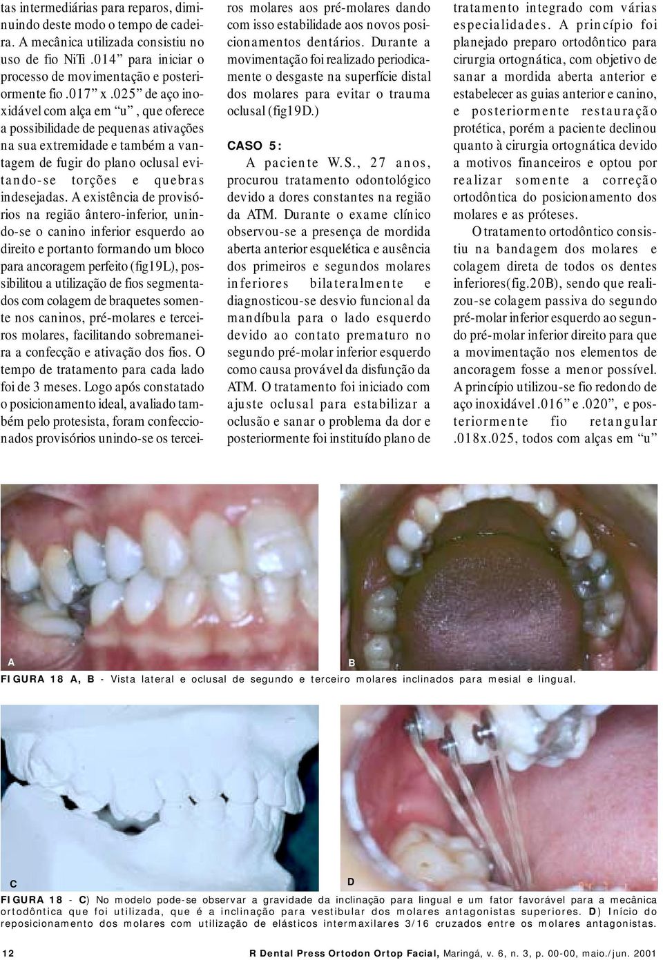 A existência de provisórios na região ântero-inferior, unindo-se o canino inferior esquerdo ao direito e portanto formando um bloco para ancoragem perfeito (fig19l), possibilitou a utilização de fios