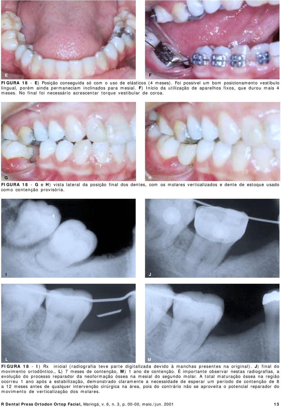 G H FIGURA 18 - G e H) vista lateral da posição final dos dentes, com os molares verticalizados e dente de estoque usado como contenção provisória.