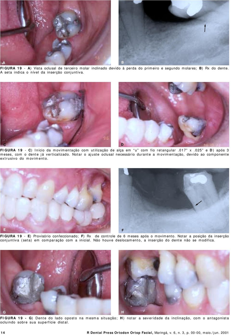 Notar o ajuste oclusal necessário durante a movimentação, devido ao componente extrusivo do movimento. E FIGURA 19 - E) Provisório confeccionado; F) Rx de controle de 6 meses após o movimento.