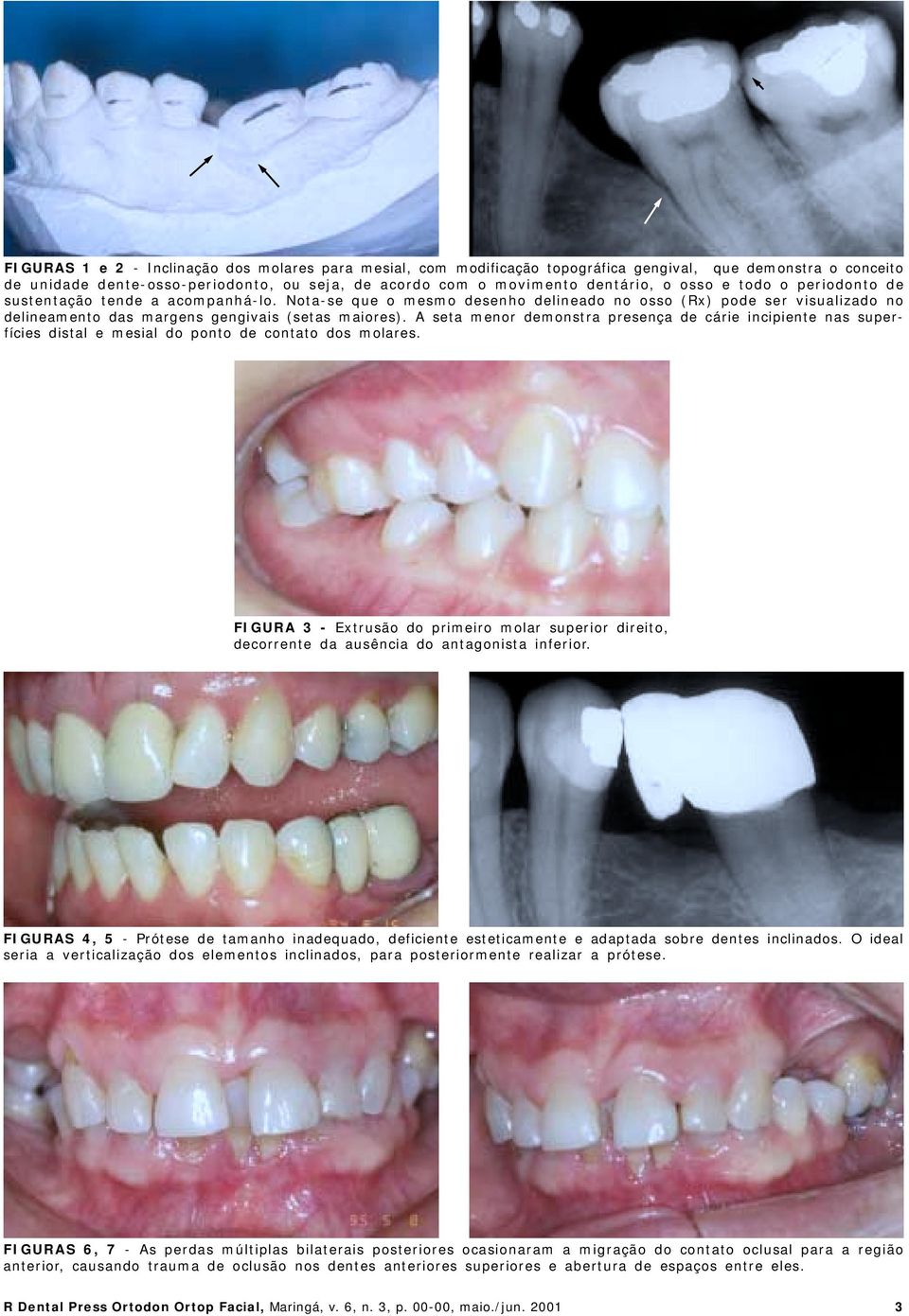 A seta menor demonstra presença de cárie incipiente nas superfícies distal e mesial do ponto de contato dos molares.