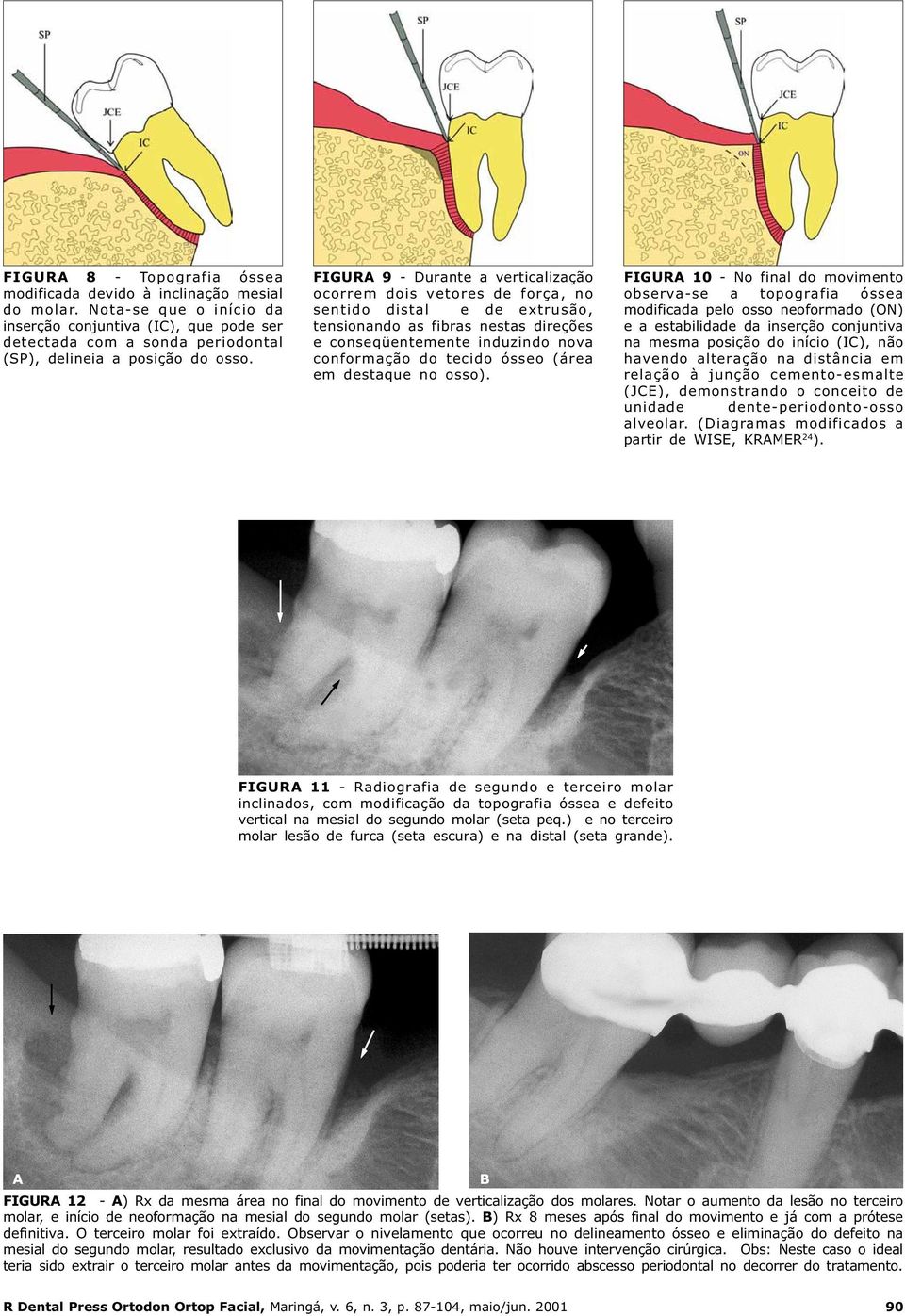 FIGURA 9 - Durante a verticalização ocorrem dois vetores de força, no sentido distal e de extrusão, tensionando as fibras nestas direções e conseqüentemente induzindo nova conformação do tecido ósseo