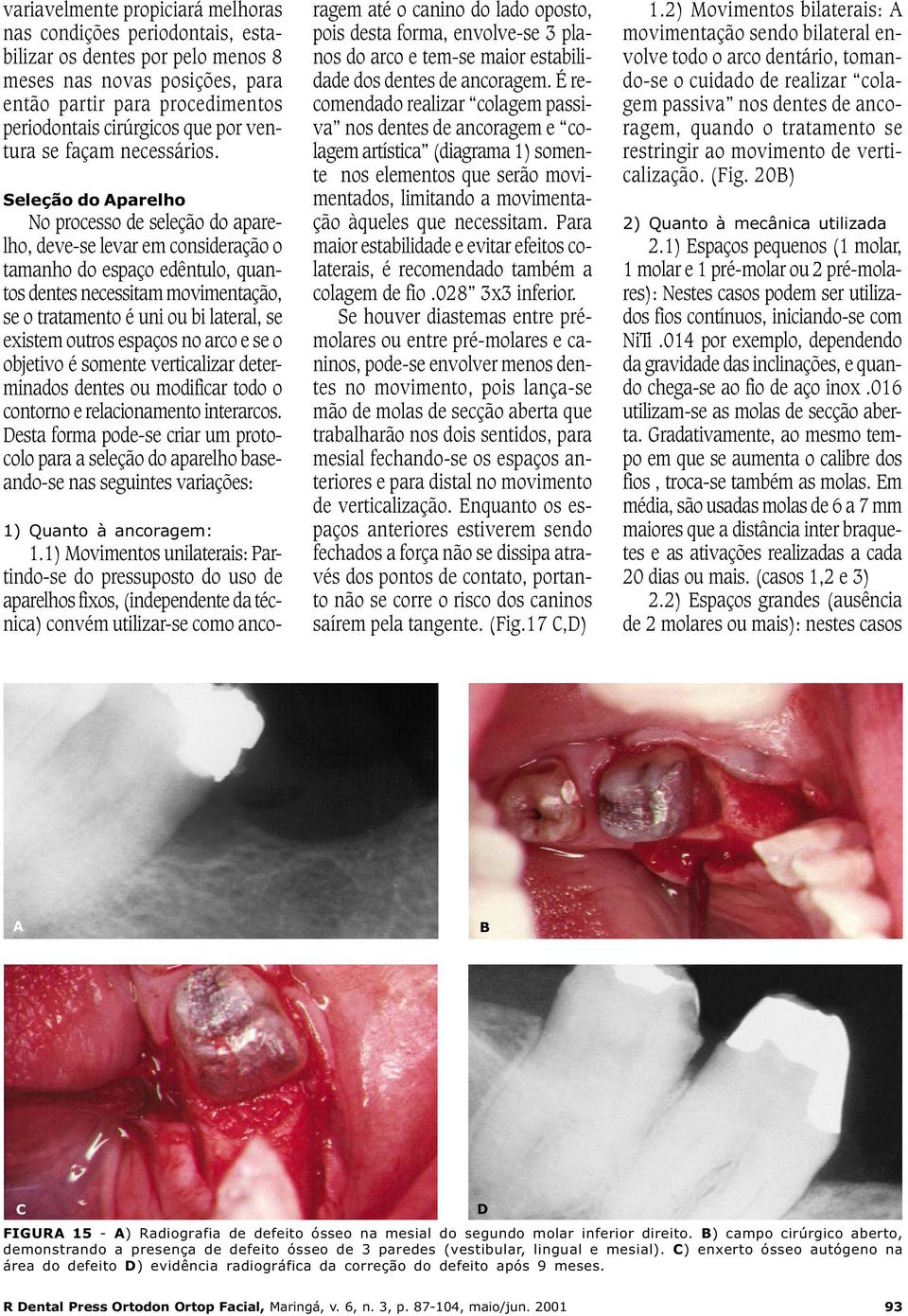 Seleção do Aparelho No processo de seleção do aparelho, deve-se levar em consideração o tamanho do espaço edêntulo, quantos dentes necessitam movimentação, se o tratamento é uni ou bi lateral, se