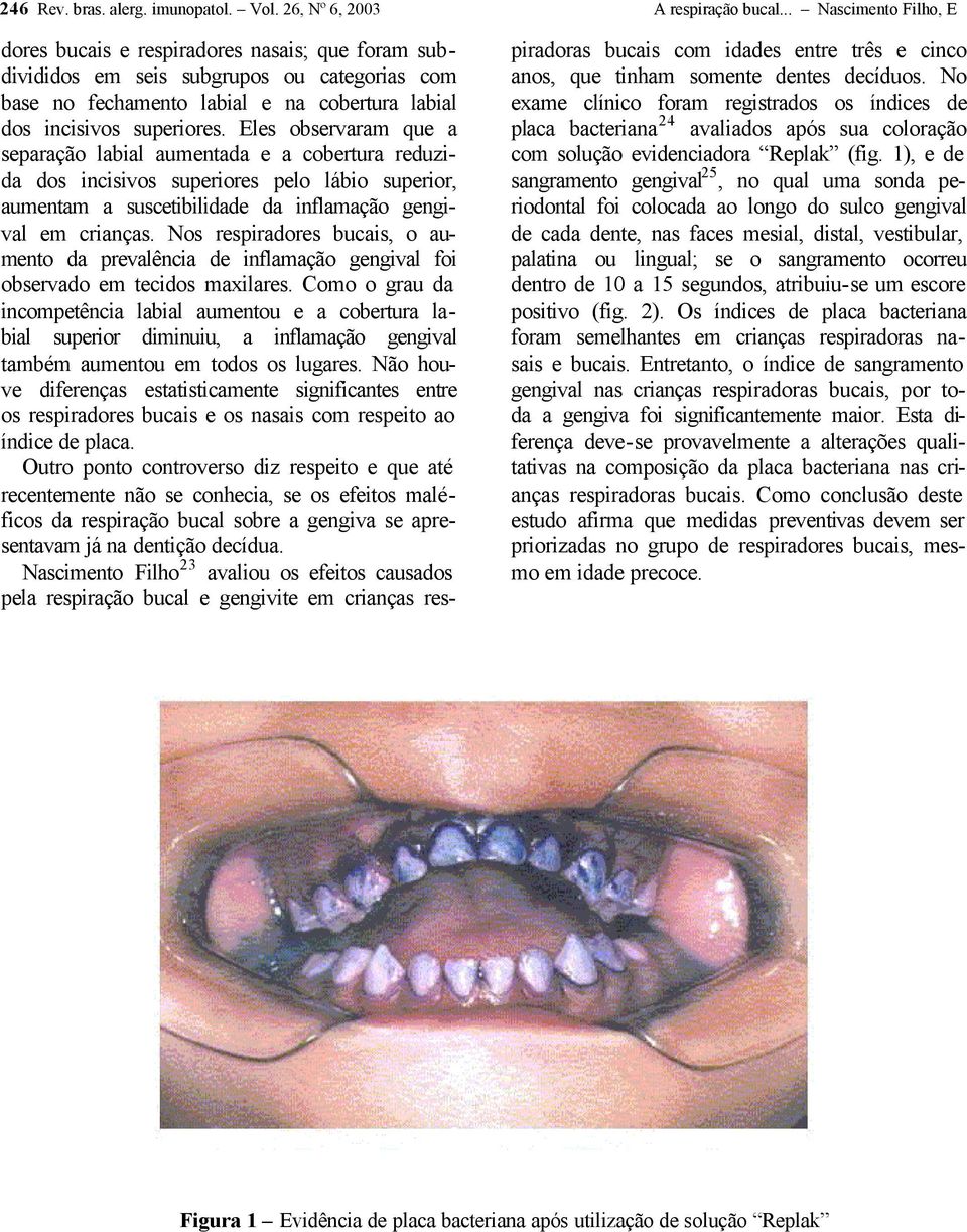 Eles observaram que a separação labial aumentada e a cobertura reduzida dos incisivos superiores pelo lábio superior, aumentam a suscetibilidade da inflamação gengival em crianças.