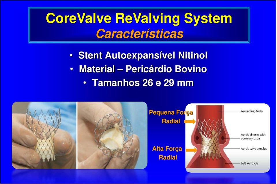 Nitinol Material Pericárdio Bovino