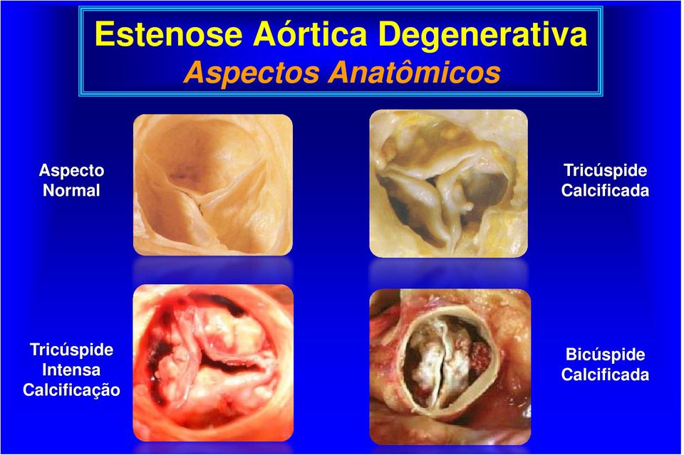 Tricúspide Calcificada Tricúspide