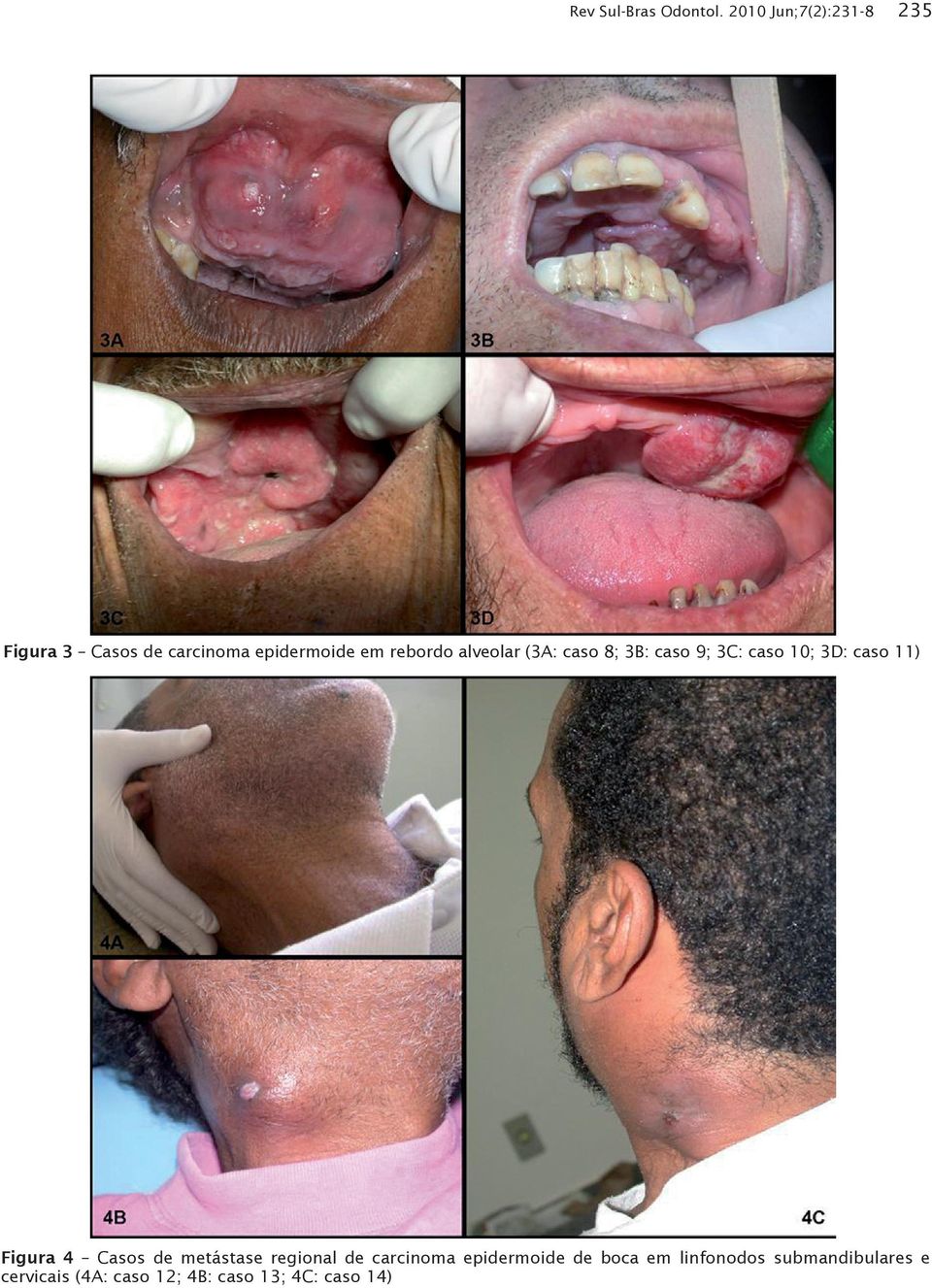 alveolar (3A: caso 8; 3B: caso 9; 3C: caso 10; 3D: caso 11) Figura 4 Casos