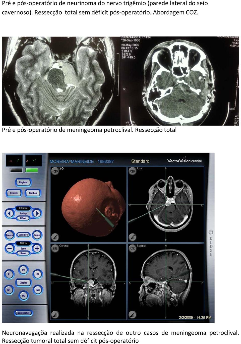 Pré e pós operatório de meningeoma petroclival.