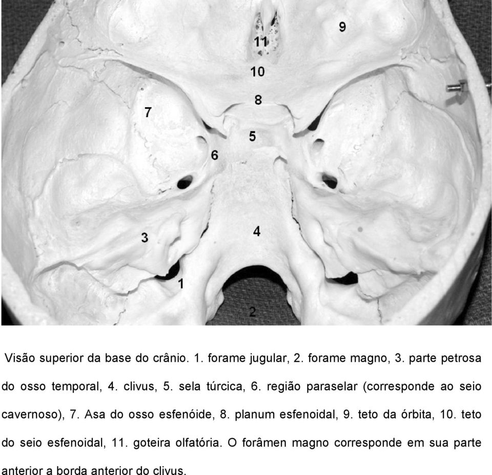 região paraselar (corresponde ao seio cavernoso), 7. Asa do osso esfenóide, 8.
