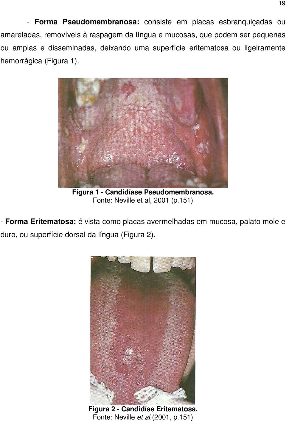 Figura 1 - Candidíase Pseudomembranosa. Fonte: Neville et al, 2001 (p.