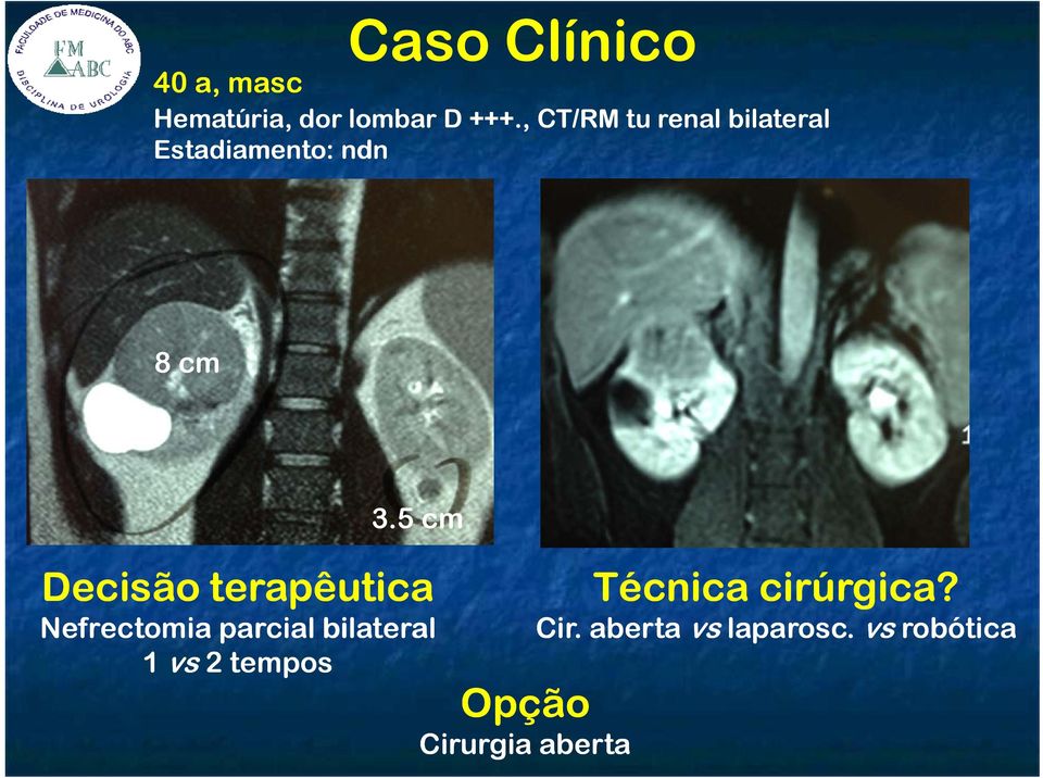5 cm Decisão terapêutica Nefrectomia parcial bilateral 1 vs