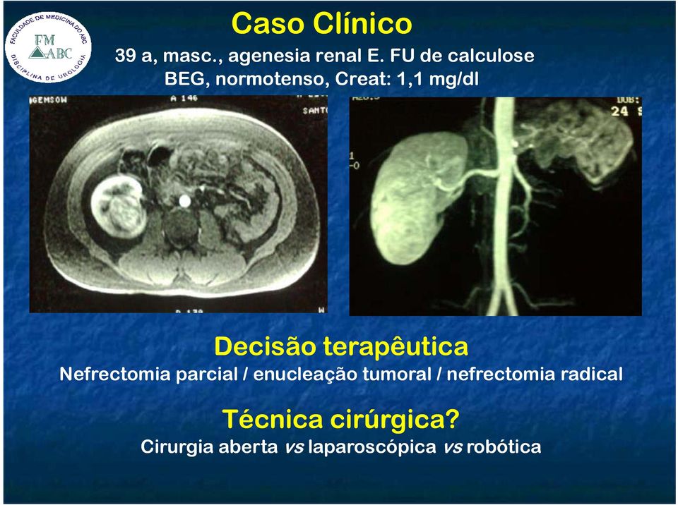 terapêutica Nefrectomia parcial / enucleação tumoral /