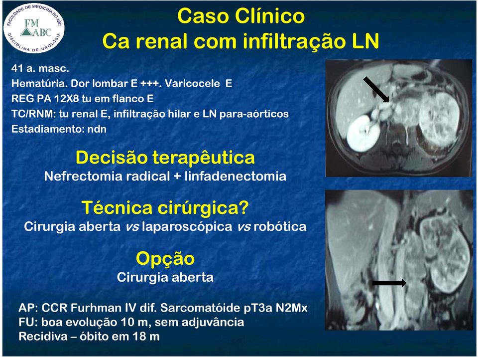 Estadiamento: ndn Decisão terapêutica Nefrectomia radical + linfadenectomia Técnica cirúrgica?