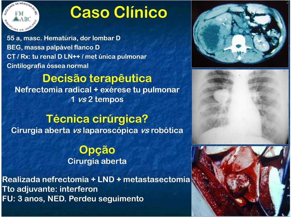 Cintilografia óssea normal Decisão terapêutica Nefrectomia radical + exérese tu pulmonar 1 vs 2