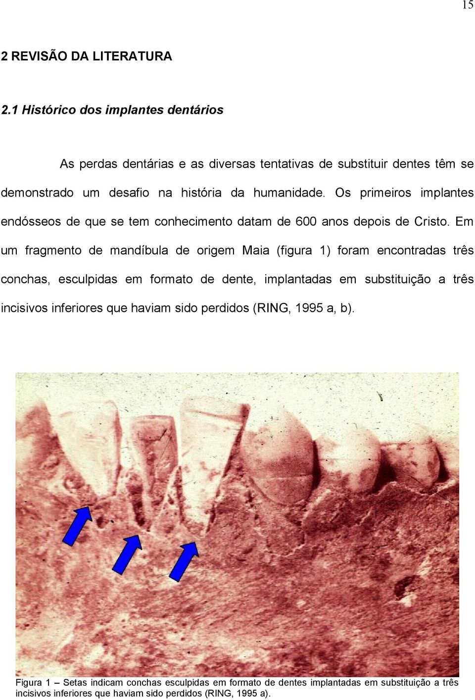 Os primeiros implantes endósseos de que se tem conhecimento datam de 600 anos depois de Cristo.