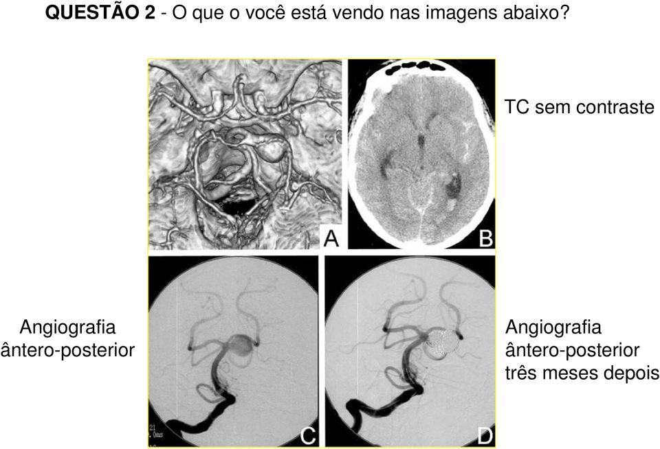 TC sem contraste Angiografia